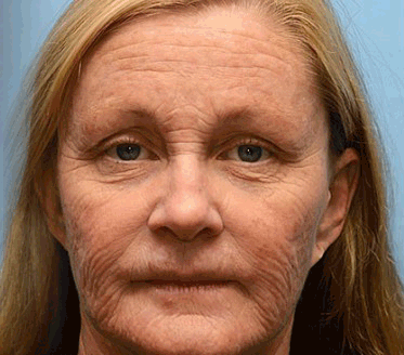 💫Newyuo Botox & Vita-A Retinol Shot Wrinkle-Lift Tightening cream